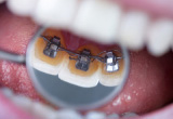 高松で矯正歯科を行う【サンシャイン歯科】では、歯の裏側から矯正する床矯正にも対応